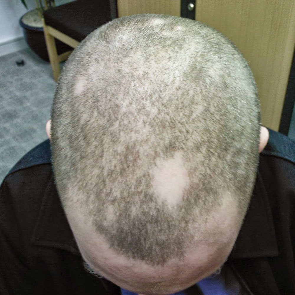 alopecia areata
