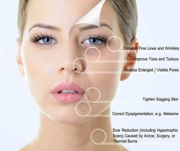 microneedling banbury
