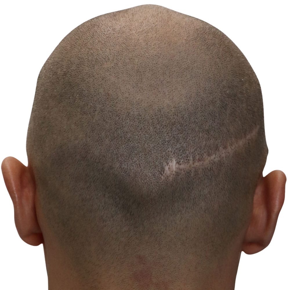 FUT Scarring