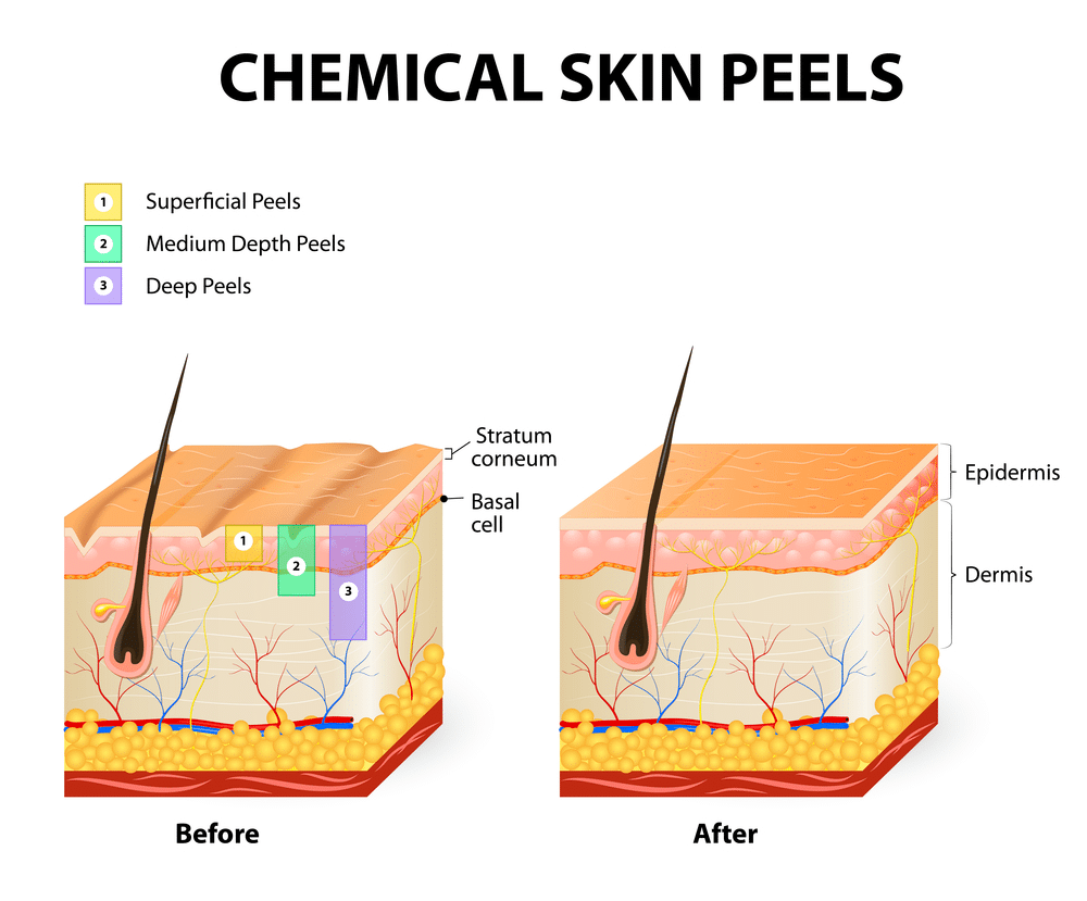skin peels banbury